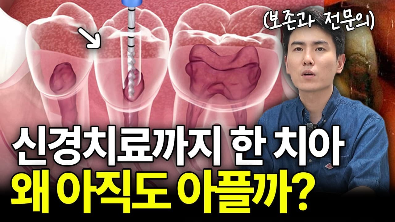 신경치료 후 한 달 넘은 통증, 참는다고 낫지 않는다 영상 썸네일