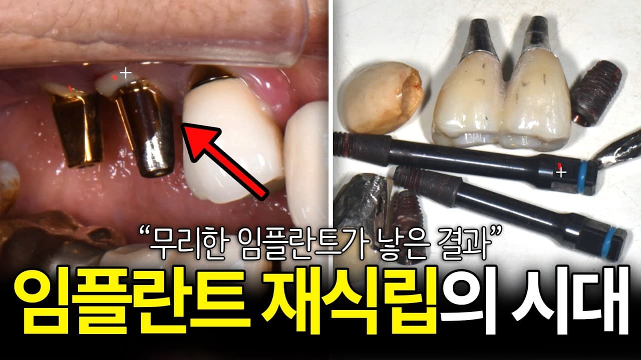 임플란트 심고 입 냄새 심해진 사람, 잇몸뼈 녹는다는 신호다 영상 썸네일