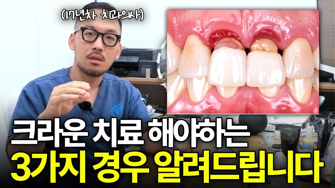 앞니 신경 죽어 까맣게 변색, 무조건 씌워야 할까. 오래전 씌운 보철물 주변으로 잇몸이 내려가 뿌리가 까맣게 드러났다.