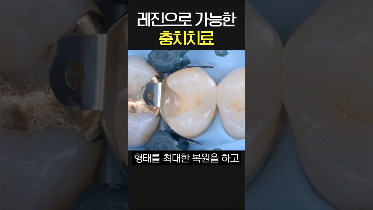 넓은 어금니 충치, 레진으로 때우면 안 되는 이유