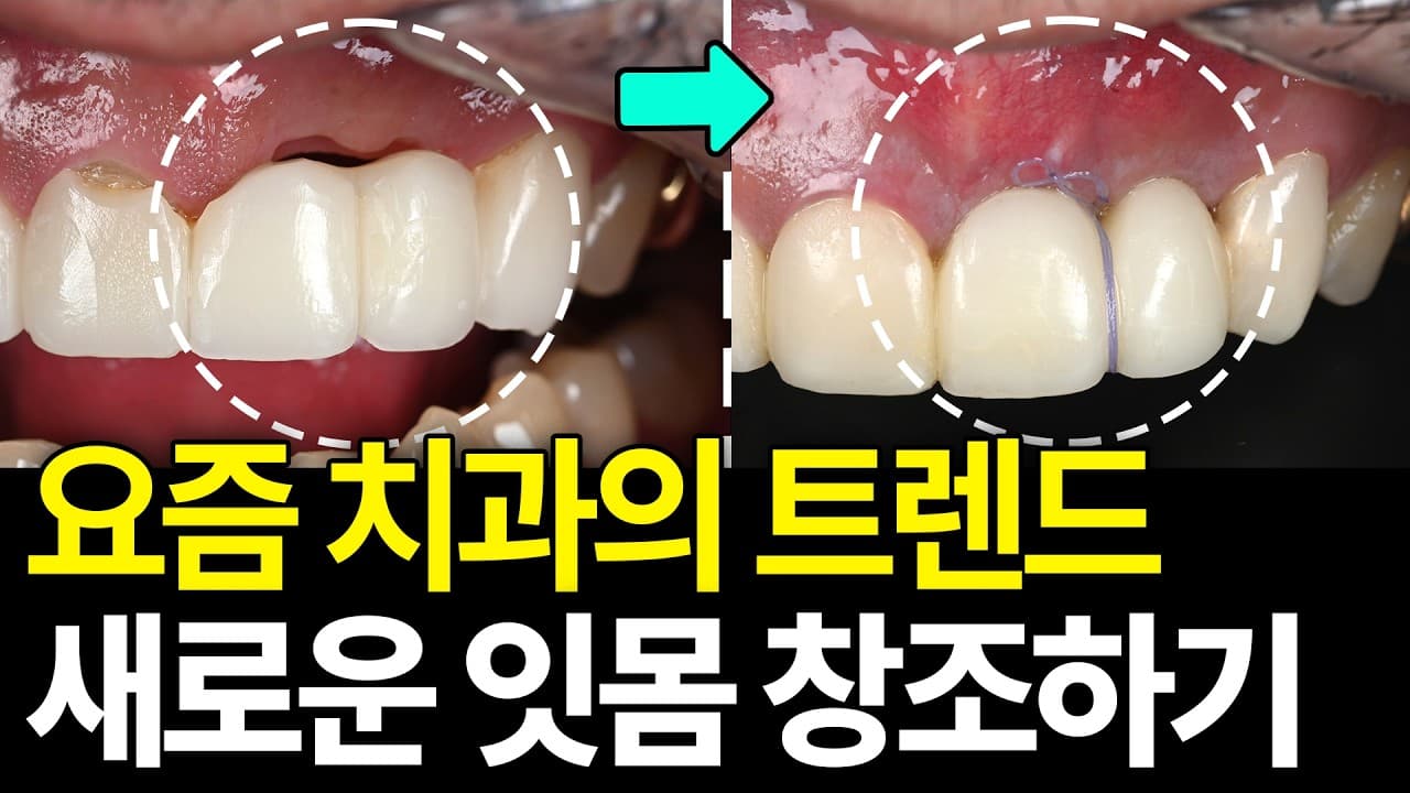 앞니 임플란트 후 길어진 치아, 뼈와 붙어도 실패다