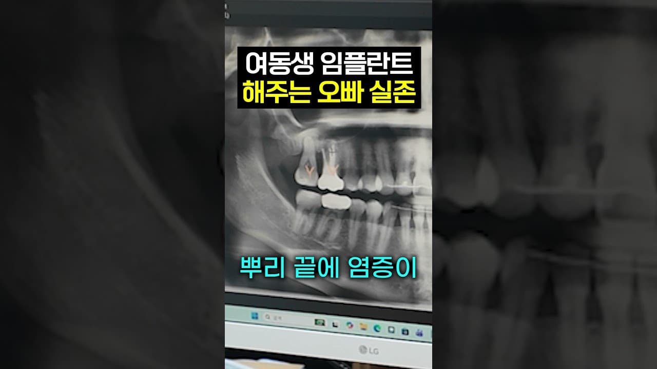 새 임플란트 씹을 때 어색한 느낌, 깎아내야 할까