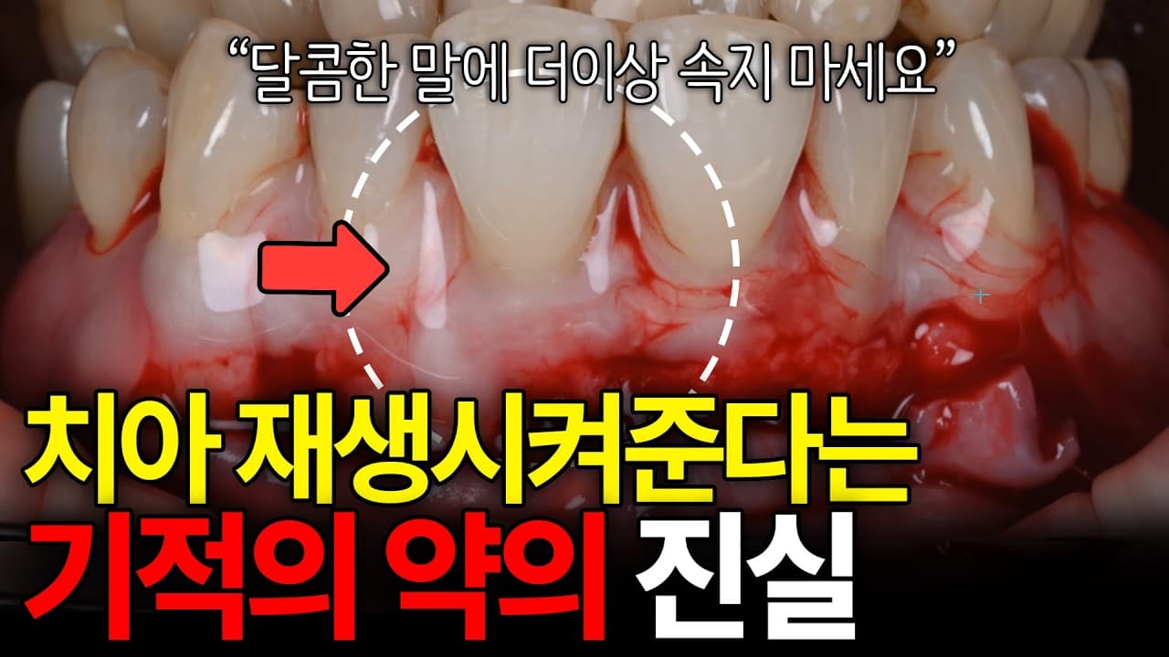 흔들리는 어금니, 비싼 재생 약재 발라도 소용없다. 잇몸뼈가 녹아 치아가 흔들리자 비싼 재생 약재부터 찾는 이들이 많다.