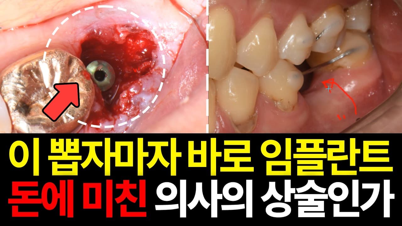 발치 후 푹 꺼진 잇몸, 뼈 이식만 하면 바로 임플란트 심을까