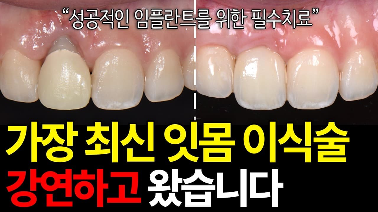 앞니 임플란트 후 길어진 치아, 잇몸이 얇아서다