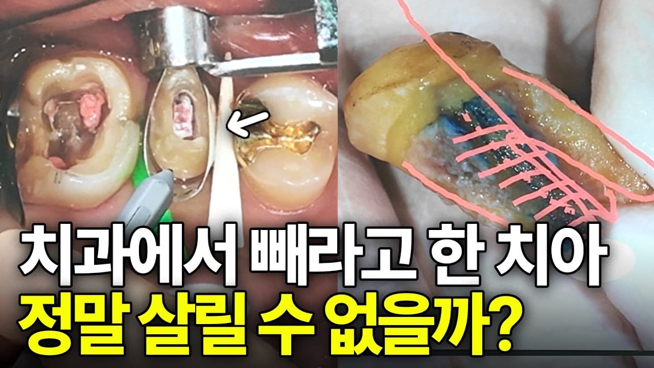 치아 발치 진단받은 사람, 무조건 버티면 잇몸뼈 잃는다 영상 썸네일