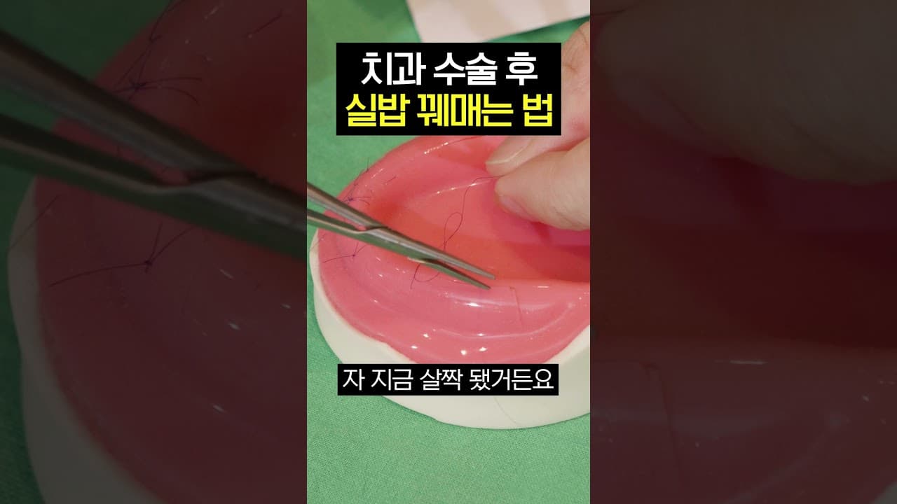 임플란트 수술 후 잇몸 꿰맨 실, 왜 굵기가 다를까. 임플란트나 사랑니 발치 같은 수술을 받고 나면 잇몸에 실밥이 남는다.
