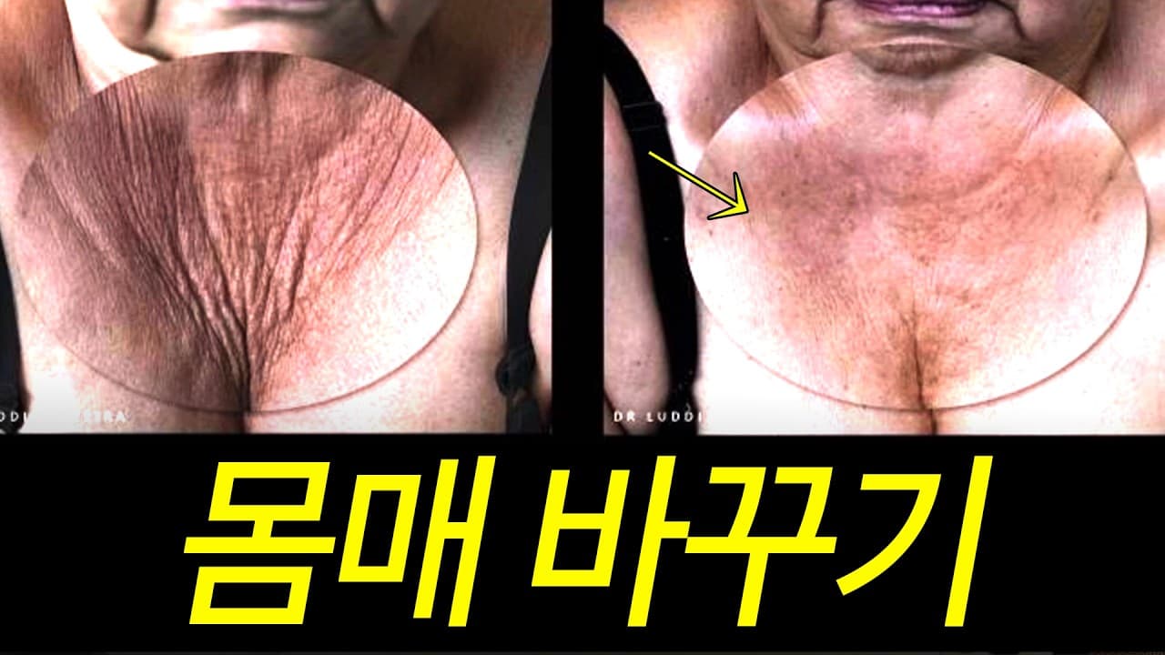 살 뺀 뒤 늘어진 뱃가죽, 운동으로 안 펴지는 이유