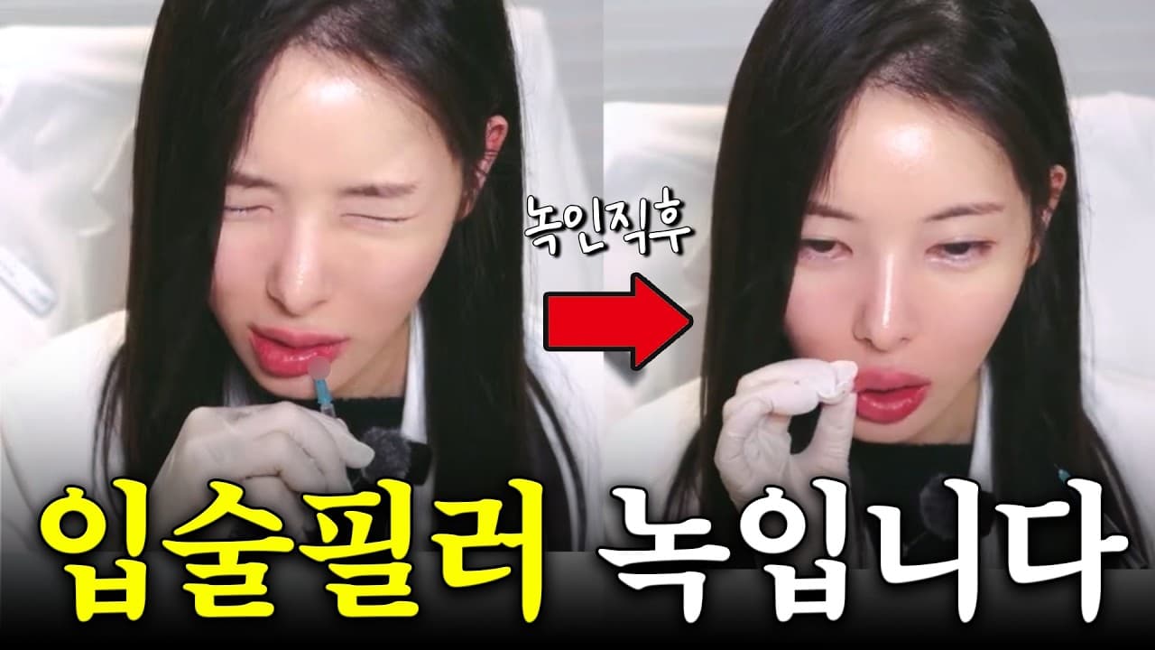 입술 필러 녹이면 울퉁불퉁해진다는 말, 반은 틀렸다 영상 썸네일