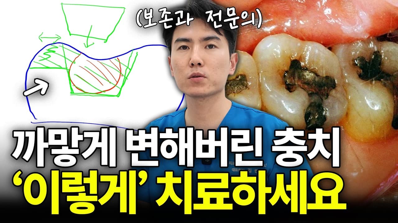 까만 점 보인다고 무조건 충치를 파내면 안 되는 이유 영상 썸네일