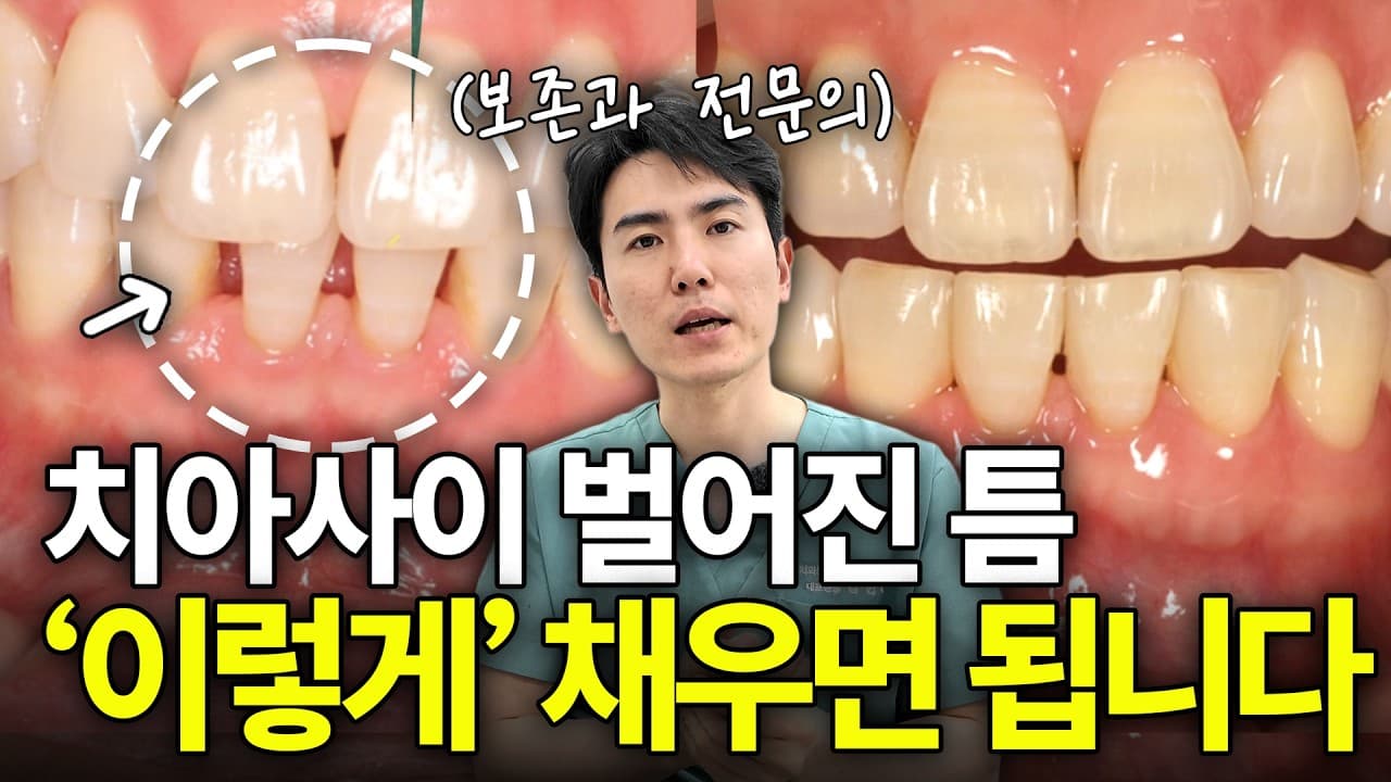 앞니 사이 까만 구멍, 스케일링 때문에 생긴 게 아니다 영상 썸네일