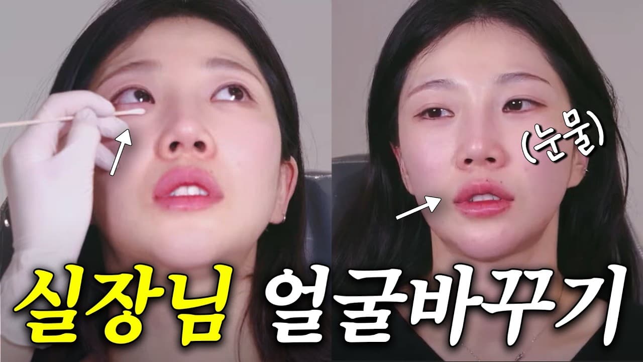 입꼬리 처졌다고 필러만 꽉 채우면 생기는 일