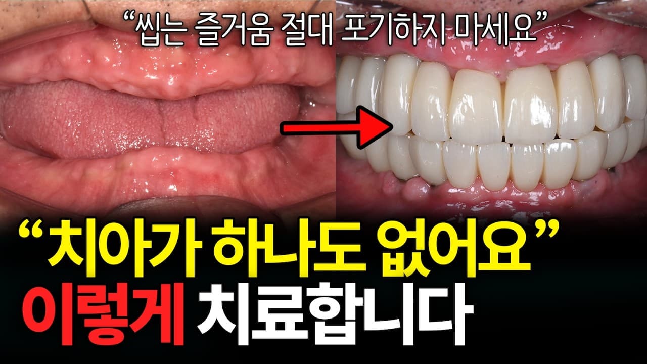 전체 임플란트, 뼈에 맞춰 심으면 치아가 길어진다