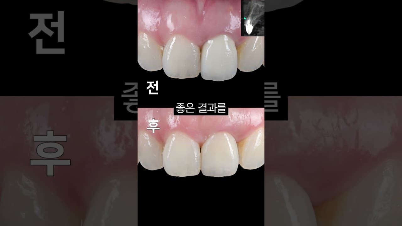 Dental Implant Key Terms