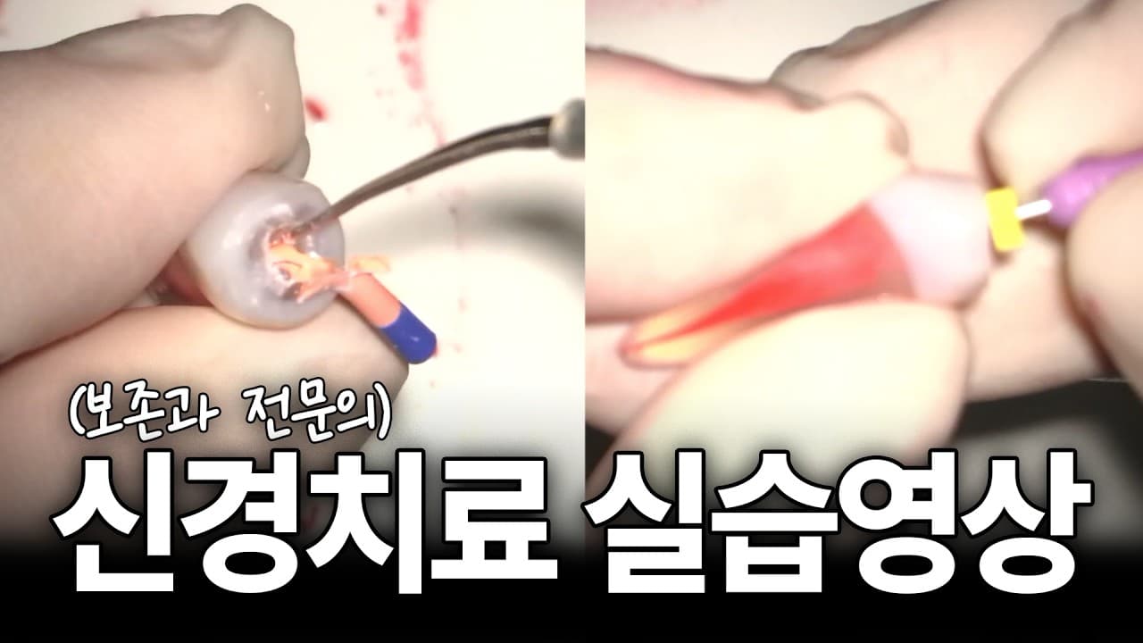 신경치료 첫 단계가 전체 결과를 가른다 영상 썸네일