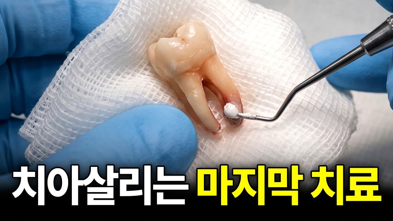 신경치료 실패했다고 꼭 뽑아야 할까 영상 썸네일