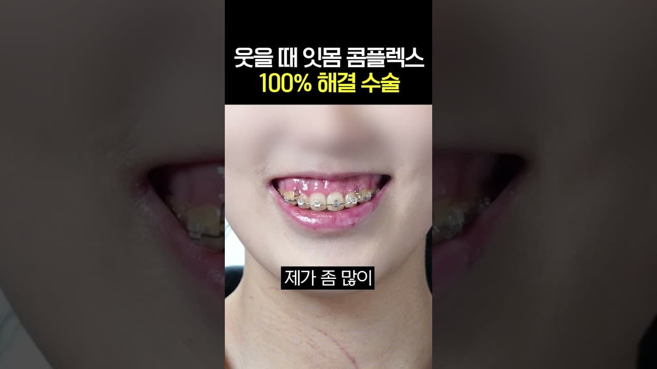 Gummy Smile Correction