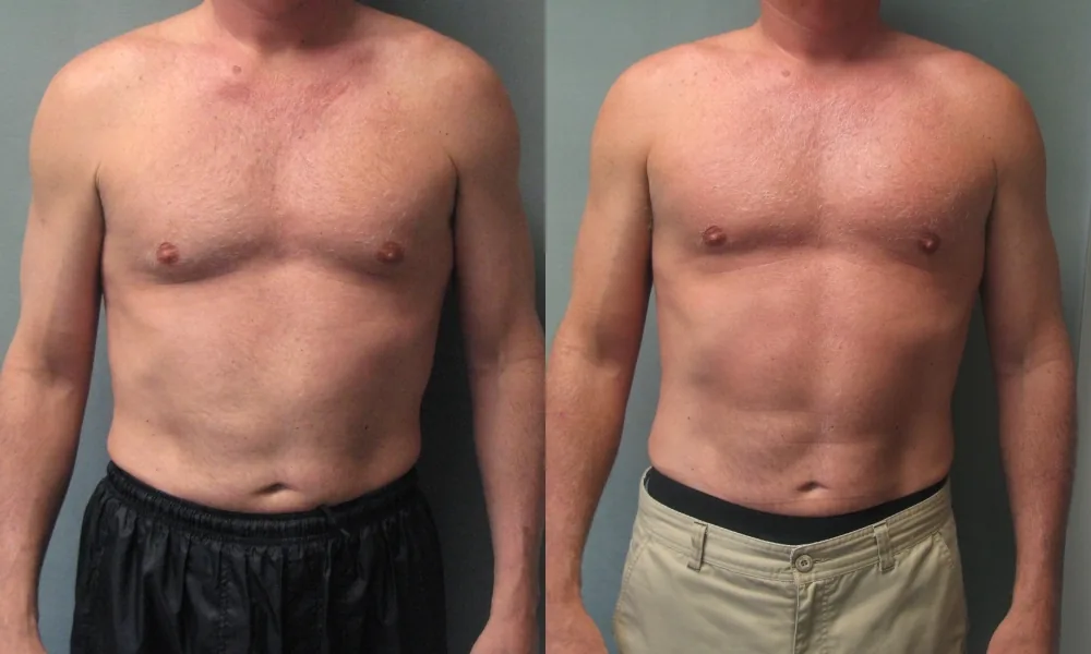 55 year old male with moderate gynecomastia before and after gynecomastia surgery