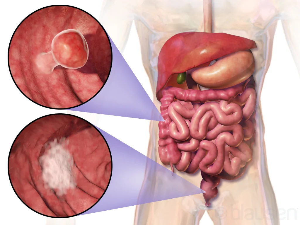 Blausen 0246 ColorectalCancer