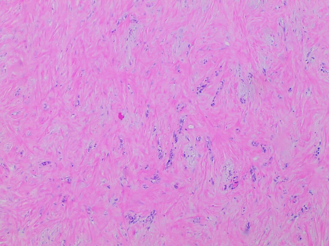 Histopathology of pancreatic adenocarcinoma with treatment effect