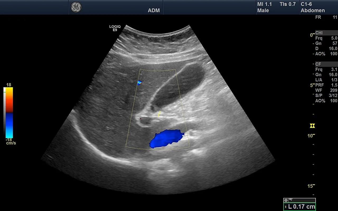 Abdominal Ultrasound General Illustration