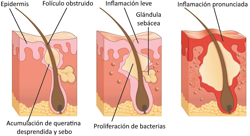 515 Acne formation-es